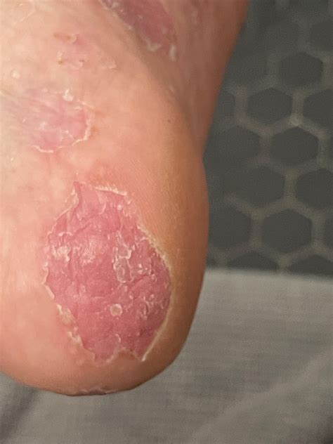 Palmoplantar Pustular Psoriasis or Dyshidrotic eczema? : r/Psoriasis