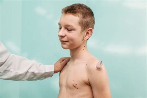 Stawianie baniek u dzieci - Blog dla fizjoterapeutów Acusmed.pl