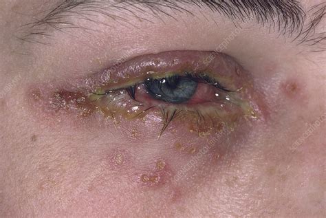 Herpes Simplex Eye