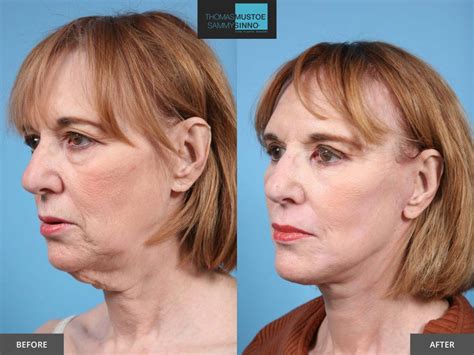 facelift      prove   natural todays