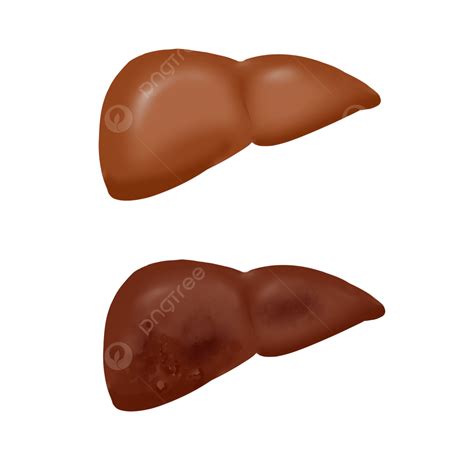 Liver Cirrhosis Liver Cancer, Human Organs, Liver, Organ PNG ...