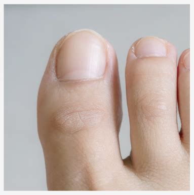 Mycose des ongles | Questionnaire
