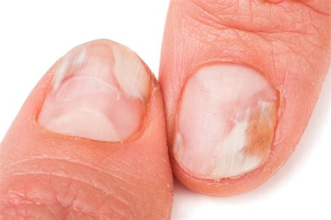Mycose des ongles : prévenir et traiter l’onychomycose - Conseils santé