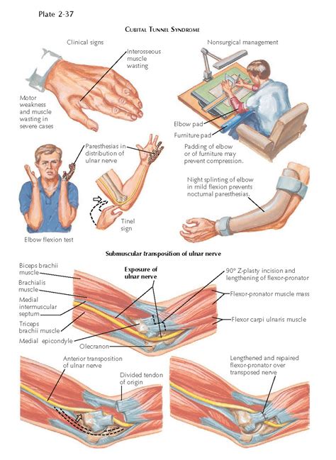 CUBITAL TUNNEL SYNDROME - pediagenosis