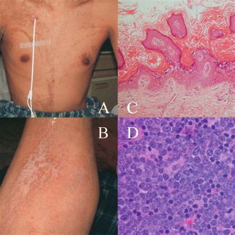(PDF) A Patient with Congenital Ichthyosis Hystrix (Disseminated ...