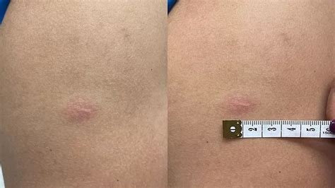 people  bcg scars  bcg vaccine
