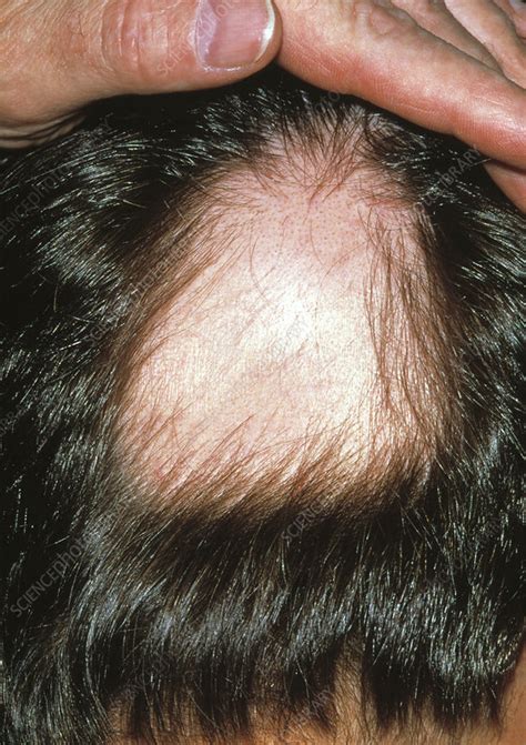 Bald patch - Stock Image - M108/0498 - Science Photo Library