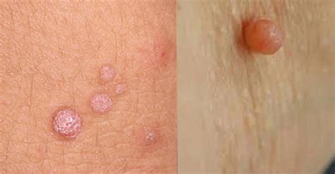 Skin Tag vs. Wart: Understanding the Difference – Skintify