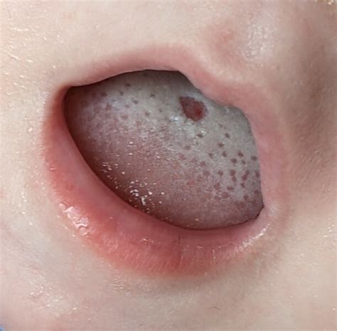spot  childs tongue  billie barker blog