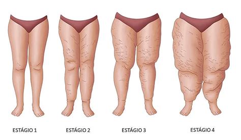 O Que É Um Lipedema - Tudo o que você Precisa Saber sobre Lipedema: O que é e Como Tratar ...