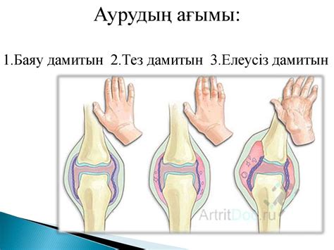 Ревматоидтты артрит - презентация онлайн