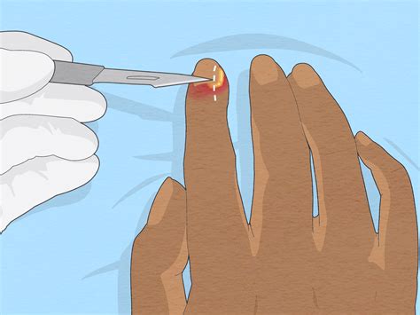 How to Treat Acute & Chronic Paronychia: Expert-Backed Tips