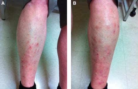 Pretibial Myxedema Without Ophthalmopathy: An Initial Presentation of ...