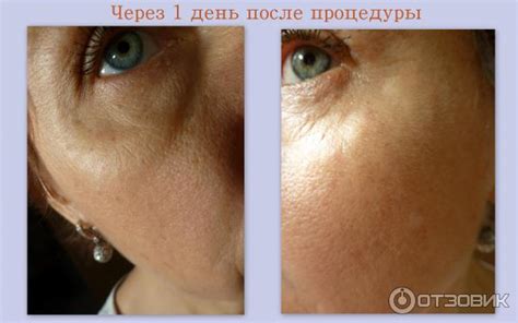Лицо после биоревитализации на следующий день: Рекомендации после ...