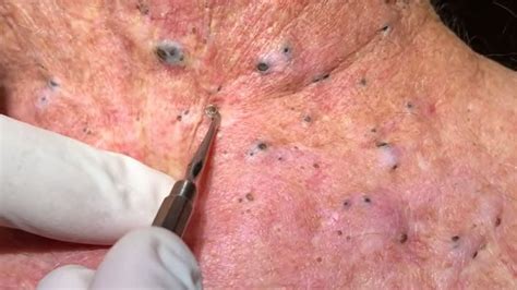 Unbelievable Blackhead Removal 2024: The Game-Changing Treatment You've Been Waiting For - 0bvwhkg