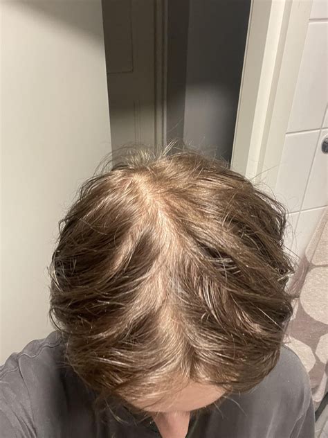 what does hair loss look like 1
