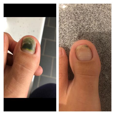Fungal Nail Treatment | Your Laser Clinic