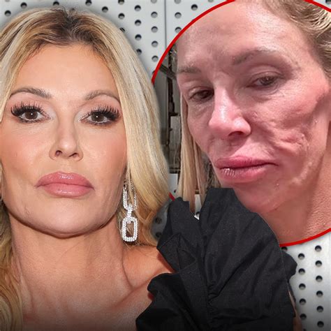 brandi glanville face condition
