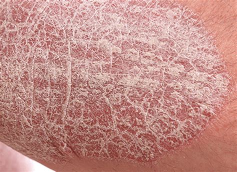 What is Psoriasis? - Daavlin