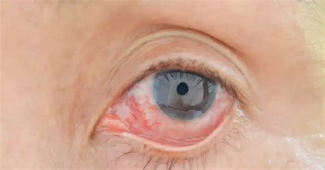 Understanding Eye Discharge: Types, Causes, and Treatments