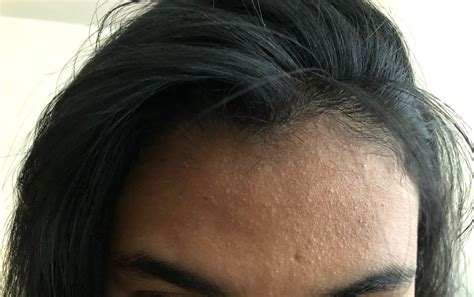 how to remove bumps from forehead