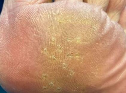 identify  treat foot corn seeds effective lasting  home