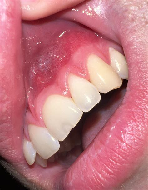 Discolored roof of mouth : r/askdentists