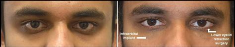 Hunter Eyes vs Prey Eyes - Mewing Appliance