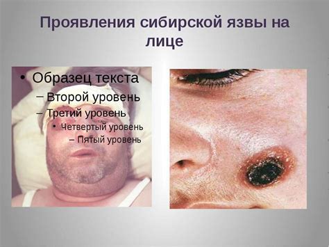 Презентация на тему "Сибирская язва" - скачать презентации по Медицине