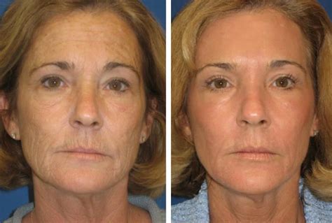 Laser Fotona Antes E Depois