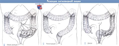 Показания, этапы, техника резекции сигмы