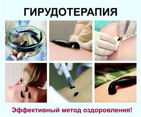 Что такое гирудотерапия? | КДЦ "Йасин"
