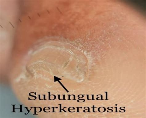 Subungual hyperkeratosis in hyponychium. | Download Scientific Diagram