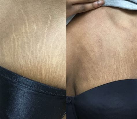 stretch marks removal treatment clinic london dermaeraze
