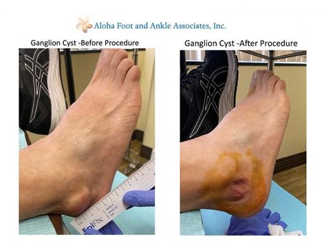 ganglion cyst aloha foot  ankle associates podiatry
