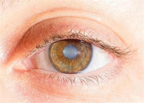 Cataract Surgery - an overview