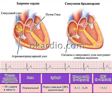 Синусовая брадикардия: виды, причины, симптомы и лечение