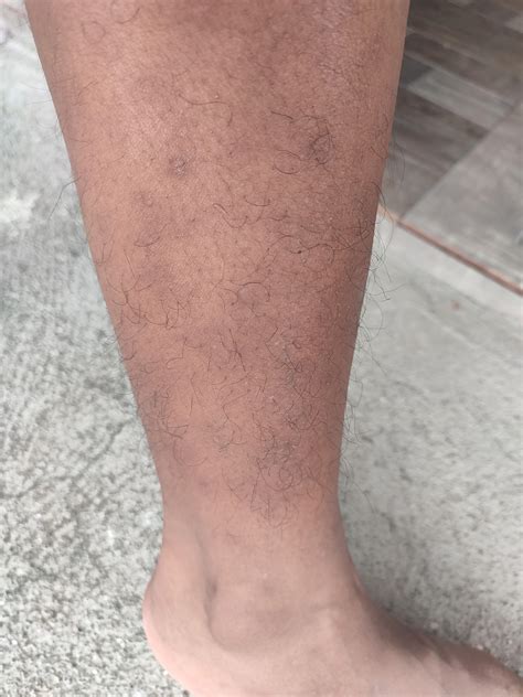 Does anyone know how to get rid of these dark marks on my legs? Its ...