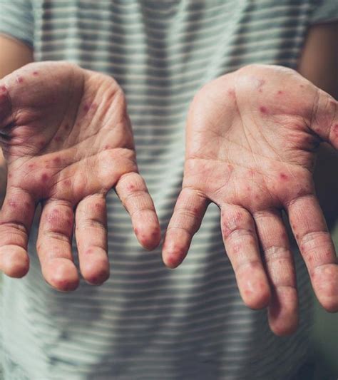 11 effective home remedies for hand foot and mouth disease – Artofit