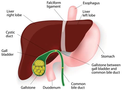 A&P Tip: Gallstone Ileus - AAPC Knowledge Center