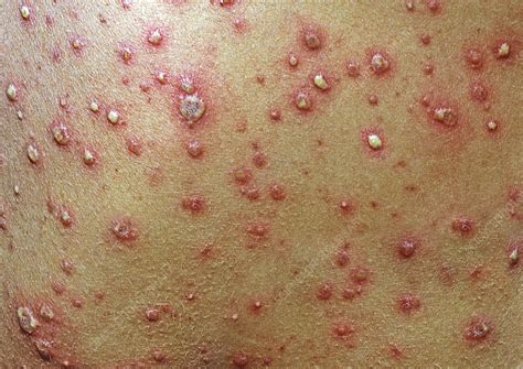 Chickenpox - Stock Image - C012/9687 - Science Photo Library