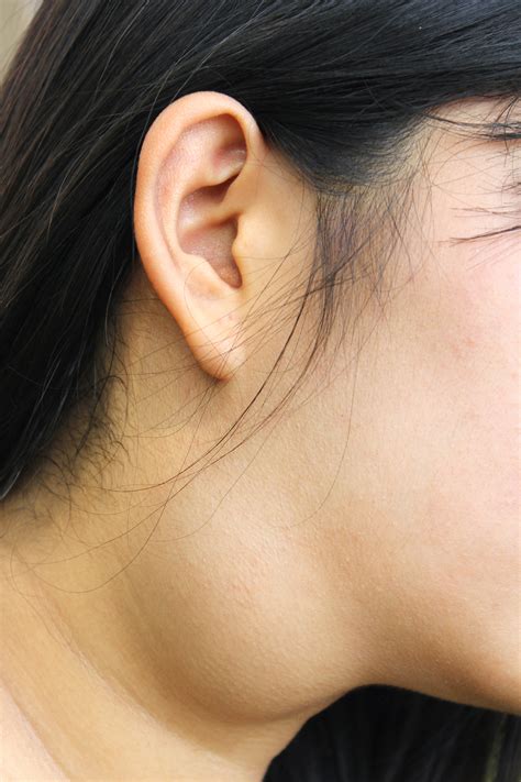 What Cancer Causes Lump In Back Of Neck - Infoupdate.org