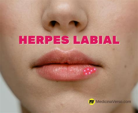 Herpes Labial E Perigoso - Herpes Labial é Contagioso: Saiba Mais Sobre a Transmissão e Prevenção ...