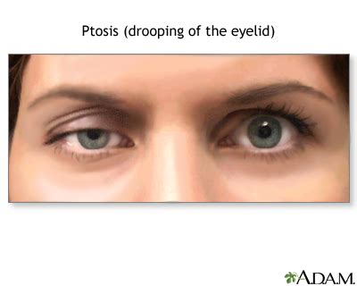 Eyelid drooping Information | Mount Sinai - New York