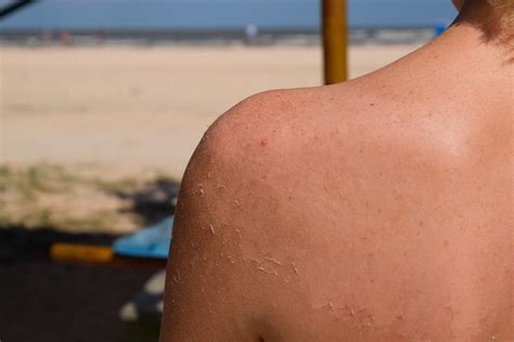 how to know if you have skin cancer from sunburn