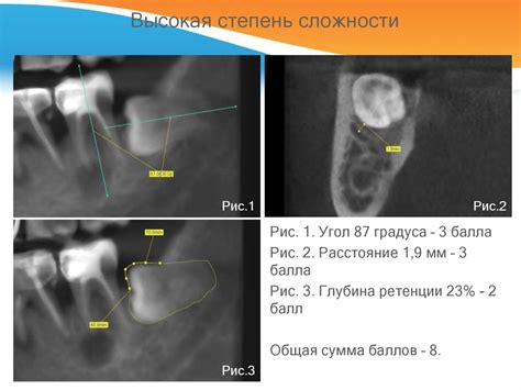 Сложность операции удаления нижних третьих моляров - презентация онлайн