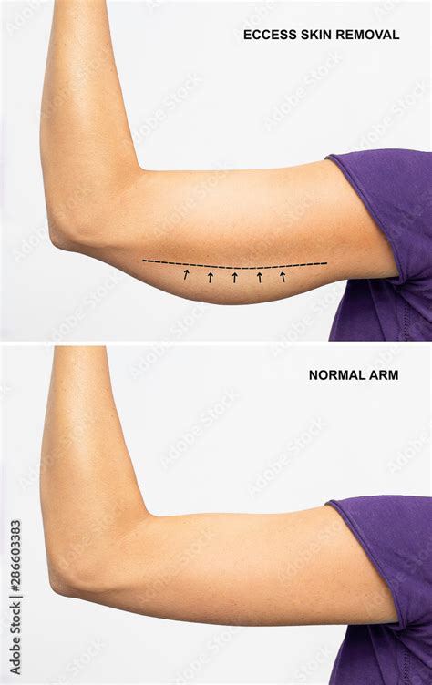 arm  excess skin  arm  normal skin