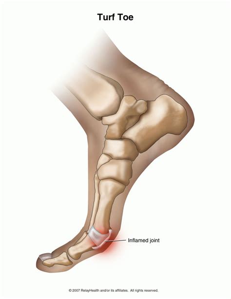 TURF TOE - MOTUS Physical Therapy