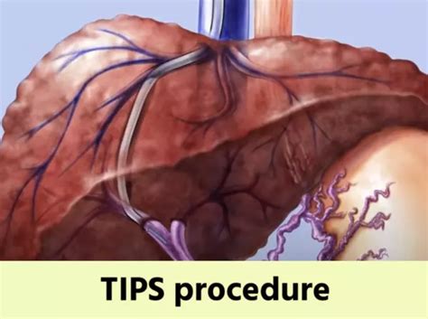 tips purpose procedure cost  prognosis