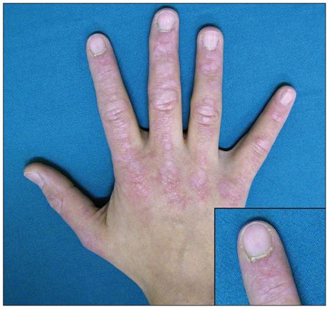 Gottrons Papules